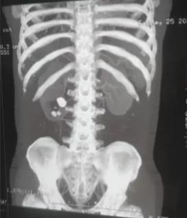 不簡單!重慶康華醫院一次手術取凈患者腎內“湯圓”狀結石