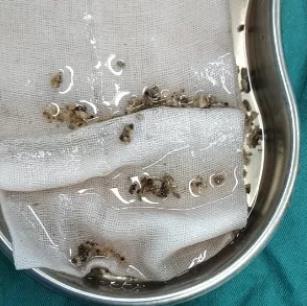 不簡單!重慶康華醫院一次手術取凈患者腎內“湯圓”狀結石