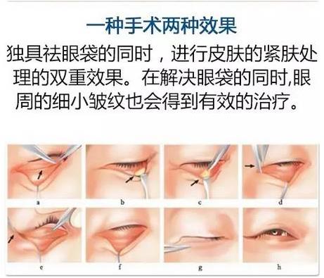 眼袋是怎么形成的,沈陽(yáng)杏林整形做眼袋多少錢(qián)
