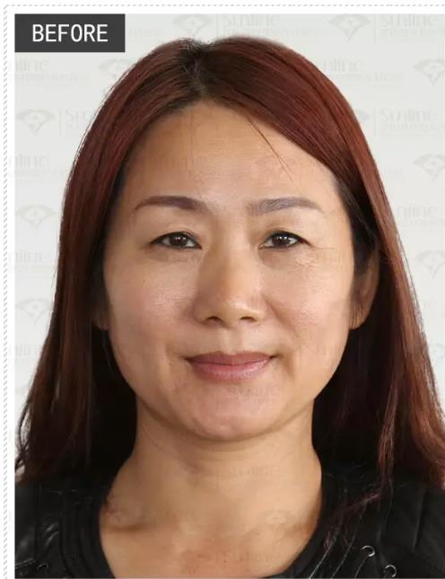 眼袋是怎么形成的,沈陽(yáng)杏林整形做眼袋多少錢(qián)