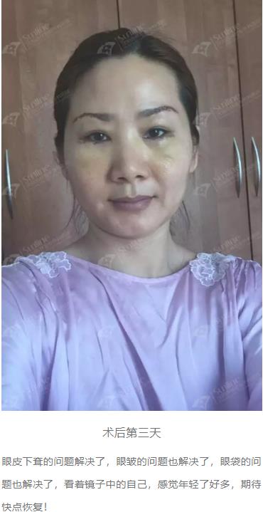 眼袋是怎么形成的,沈陽(yáng)杏林整形做眼袋多少錢(qián)