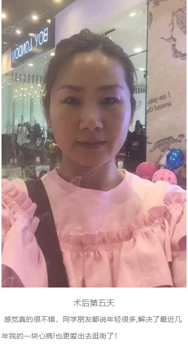 眼袋是怎么形成的,沈陽(yáng)杏林整形做眼袋多少錢(qián)