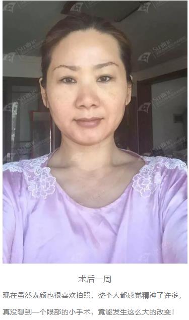 眼袋是怎么形成的,沈陽(yáng)杏林整形做眼袋多少錢(qián)