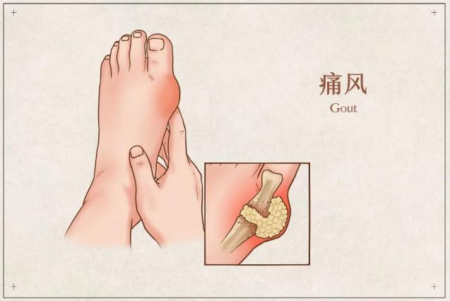 痛風那些事兒 | 龍蝦加啤酒,痛到沒朋友?