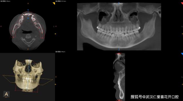 武漢仁愛口腔醫師告訴你正畸前為什么要拍片