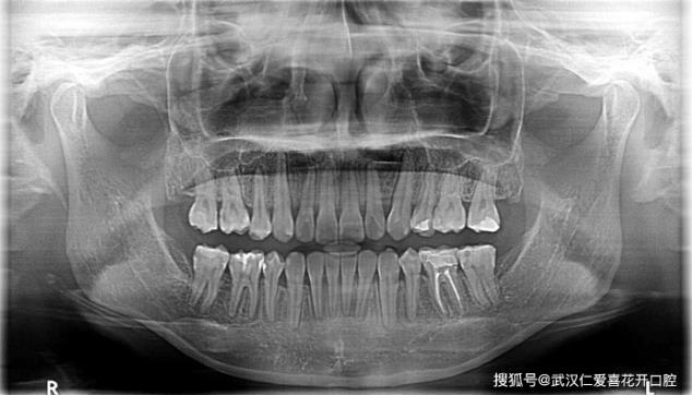 武漢仁愛口腔醫師告訴你正畸前為什么要拍片