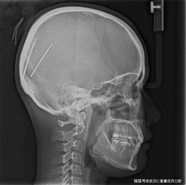 武漢仁愛口腔醫師告訴你正畸前為什么要拍片