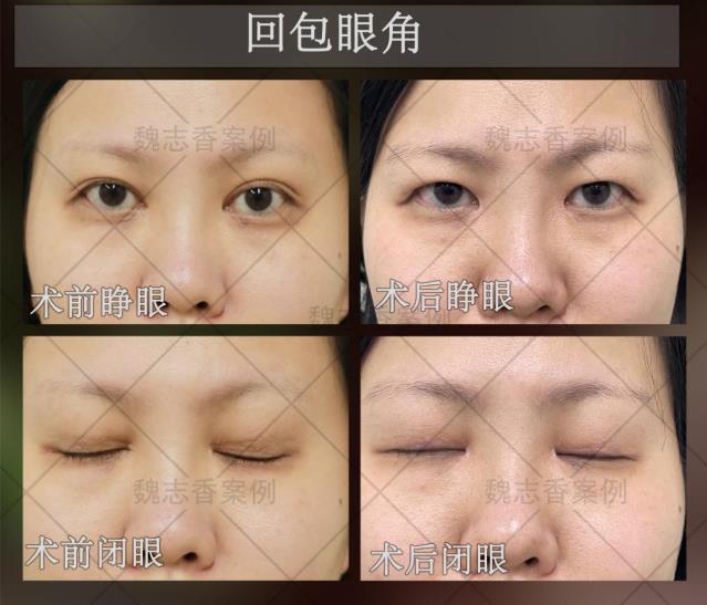 開了內(nèi)眼角過大要怎么修復,魏志香是如何修復的呢?