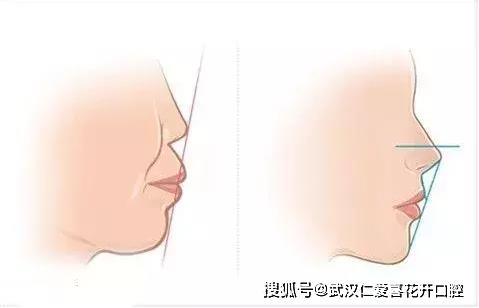 武漢仁愛口腔醫生告訴你寶寶替牙期千萬別吃軟食