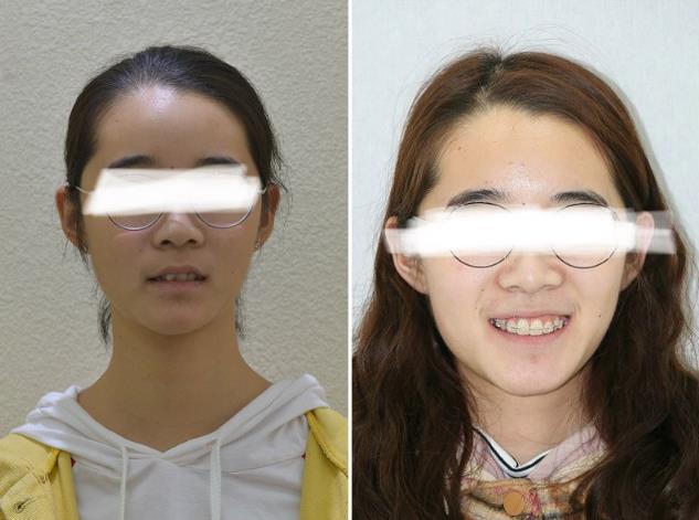 武漢仁愛口腔醫院靠譜嗎?三甲名醫云集展示種牙和正畸優質案例