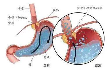呼市東大肛腸醫院 反胃、吐酸水?胃酸過多是一種怎樣的體驗?