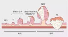 廣東民安醫(yī)院怎么樣:這么年輕,也沒家族史,30歲的他為什么會(huì)查出直腸癌?