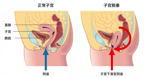大連美琳達婦科醫(yī)院:關于漏尿,眾多女性的難言之隱怎么改