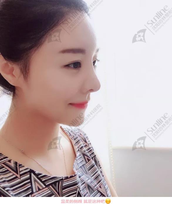 沈陽杏林整形隆鼻費(fèi)用貴嗎 效果好不好