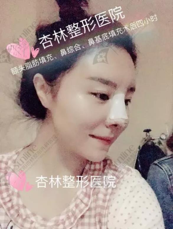沈陽杏林整形隆鼻費(fèi)用貴嗎 效果好不好