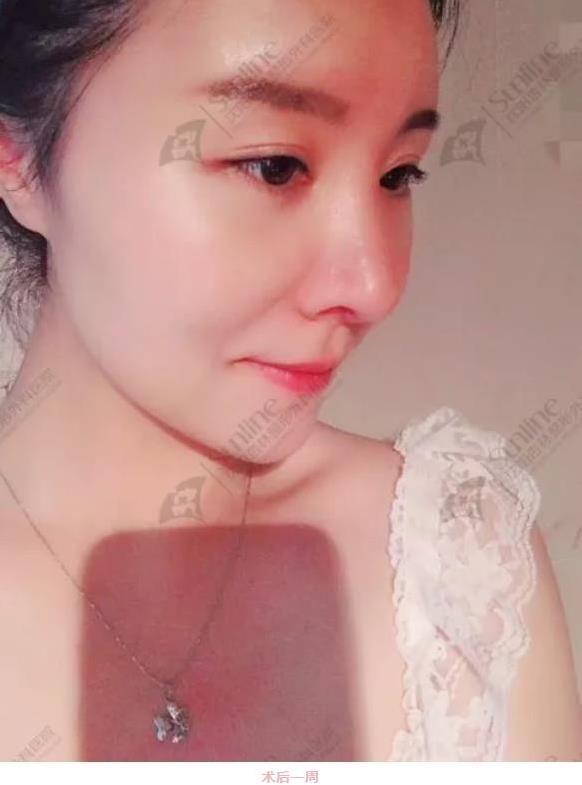 沈陽杏林整形隆鼻費(fèi)用貴嗎 效果好不好