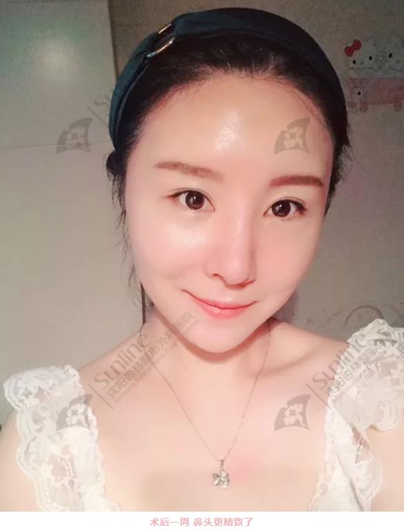 沈陽杏林整形隆鼻費(fèi)用貴嗎 效果好不好