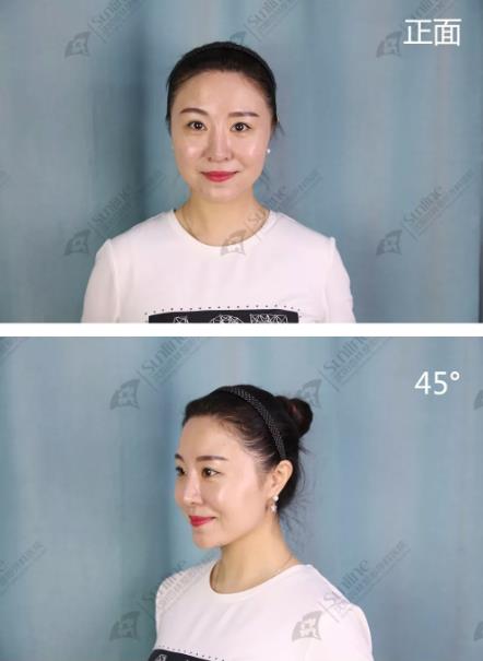 沈陽杏林整形隆鼻費(fèi)用貴嗎 效果好不好