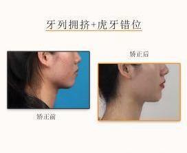 網(wǎng)友:牙齒不齊想矯正但又不想拔牙該怎么治療?仁愛口腔醫(yī)師表示不拔牙也能讓你擁有一副微笑臉!