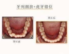 網(wǎng)友:牙齒不齊想矯正但又不想拔牙該怎么治療?仁愛口腔醫(yī)師表示不拔牙也能讓你擁有一副微笑臉!