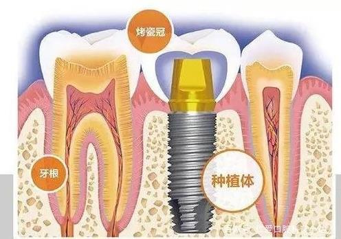 網友:缺牙怎么辦?武漢仁愛口腔種植專家帶您直擊種植手術現場,見證缺牙重生的秘密!