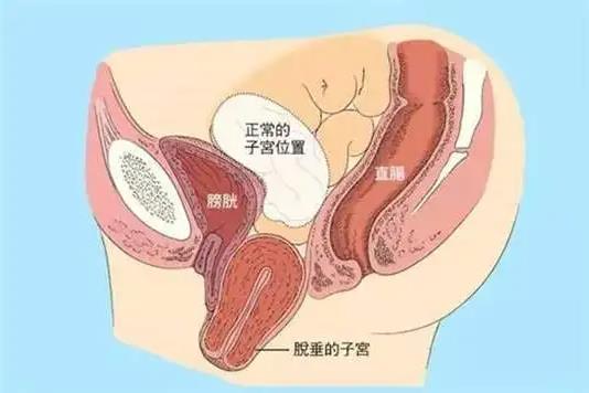 鄭州美中商都婦產醫院看子宮脫垂怎么樣 幫助無數患者重塑健康