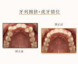 網(wǎng)友:牙齒不齊想矯正但又不想拔牙該怎么治療?仁愛口腔醫(yī)師表示不拔牙也能讓你擁有一副微笑臉!