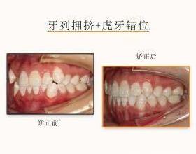 網(wǎng)友:牙齒不齊想矯正但又不想拔牙該怎么治療?仁愛口腔醫(yī)師表示不拔牙也能讓你擁有一副微笑臉!