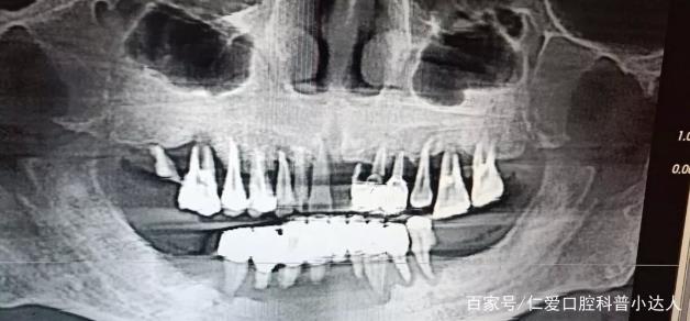網友:缺牙怎么辦?武漢仁愛口腔種植專家帶您直擊種植手術現場,見證缺牙重生的秘密!