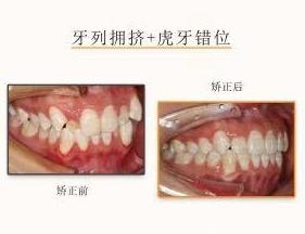 網(wǎng)友:牙齒不齊想矯正但又不想拔牙該怎么治療?仁愛口腔醫(yī)師表示不拔牙也能讓你擁有一副微笑臉!