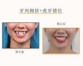 網(wǎng)友:牙齒不齊想矯正但又不想拔牙該怎么治療?仁愛口腔醫(yī)師表示不拔牙也能讓你擁有一副微笑臉!
