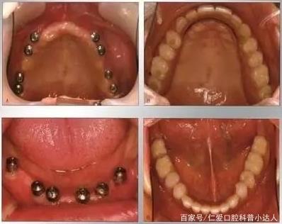 網友:缺牙怎么辦?武漢仁愛口腔種植專家帶您直擊種植手術現場,見證缺牙重生的秘密!