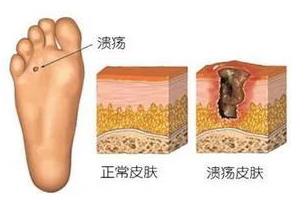 圣嘉新蘇敬達:大腳骨手術微創的好還是傳統的好?怎么治療徹底?