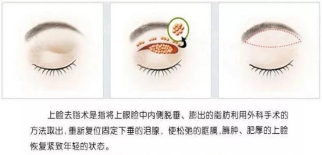 怎么設計才會好看 割雙眼皮就來南通初戀眼整形中心