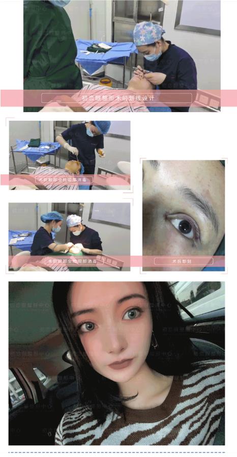怎么設計才會好看 割雙眼皮就來南通初戀眼整形中心