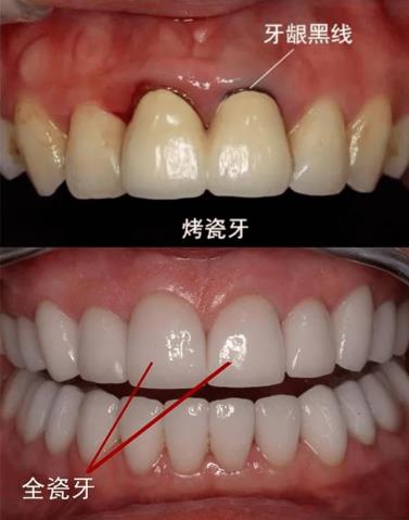 武漢仁愛口腔全瓷牙效果如何?能用多久?有什么優(yōu)勢?