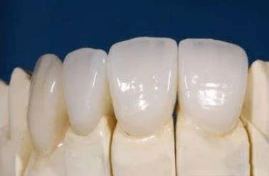武漢仁愛口腔全瓷牙效果如何?能用多久?有什么優(yōu)勢?