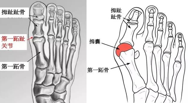 大腳骨醫生蘇敬達:大腳骨的保守治療方法有效果嗎?