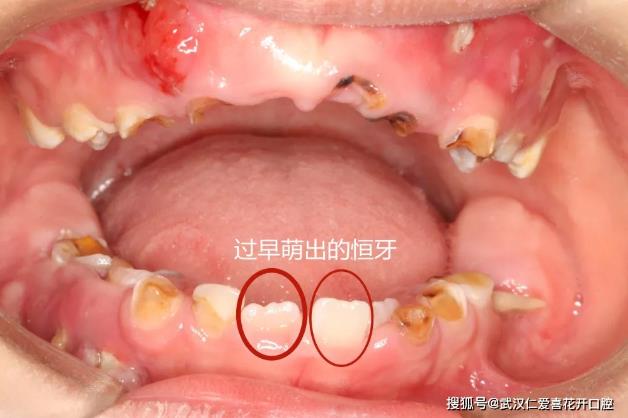 武漢仁愛(ài)口腔案例表示:“猛性齲”未及時(shí)治療,4歲男童一口牙幾乎爛光