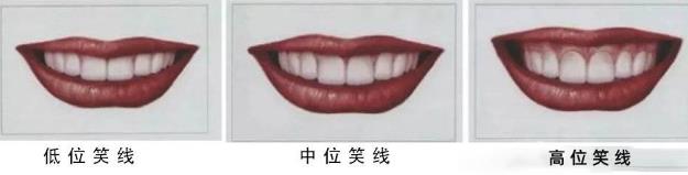 武漢仁愛口腔怎么樣?網友:為什么我笑的呆板顯老?牙醫:牙齒矯正中不可忽視的微笑線!