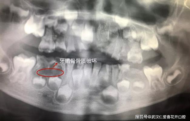 武漢仁愛(ài)口腔案例表示:“猛性齲”未及時(shí)治療,4歲男童一口牙幾乎爛光