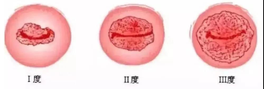 武漢仁愛醫院婦科:得宮頸炎的時候,身體發出的這些信號你居然不知道?