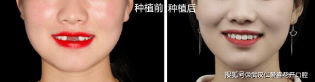 武漢仁愛口腔:種植牙真的能做嗎?20歲女孩的真實案例,告訴你種牙到底值不值!