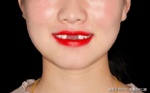 武漢仁愛口腔:種植牙真的能做嗎?20歲女孩的真實案例,告訴你種牙到底值不值!