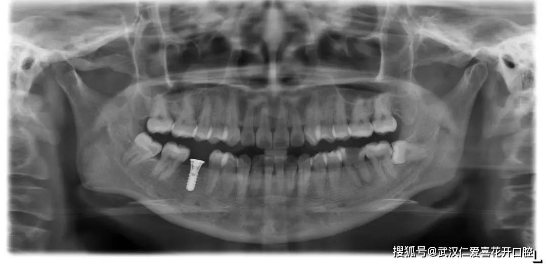 武漢仁愛口腔:種牙親身經歷分享(歷時4個月),解決年輕人的蛀牙缺牙煩惱!