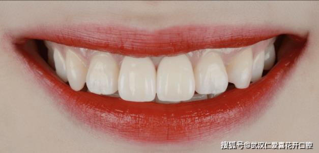 武漢仁愛口腔:種植牙真的能做嗎?20歲女孩的真實案例,告訴你種牙到底值不值!