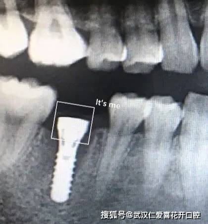 武漢仁愛口腔:種牙親身經歷分享(歷時4個月),解決年輕人的蛀牙缺牙煩惱!