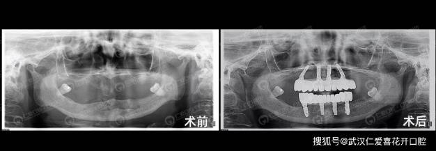 武漢仁愛口腔種植案例60歲王阿姨長“新牙”,多虧了“數字化即刻”種植!