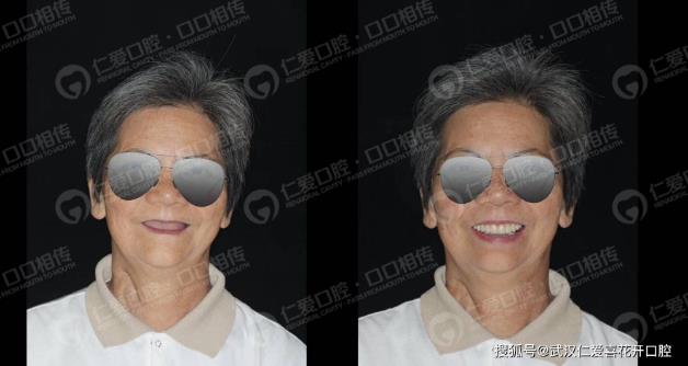 武漢仁愛口腔種植案例60歲王阿姨長“新牙”,多虧了“數字化即刻”種植!