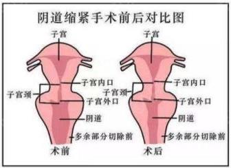 重慶軍科私密整形醫(yī)院——什么是陰道緊縮術(shù)?